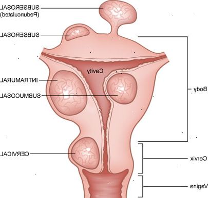 Fibroida smärta: bortom livmodern