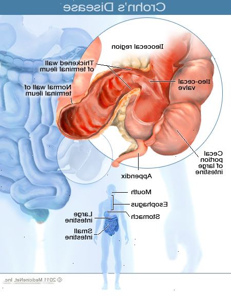 Hur är Crohns sjukdom behandlas?