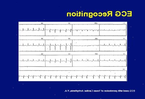 Den förmaksflimmer diagnos process